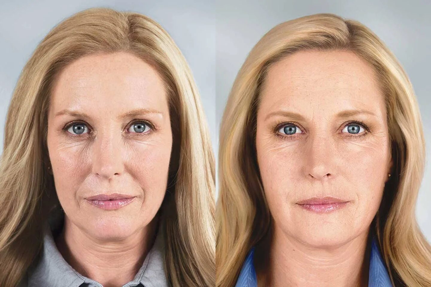 ботокс для лица до и после. рф лифтинг вокруг глаз. лифтинг нижних век. морщины 35 лет отзывы. морщины 35 лет отзывы.