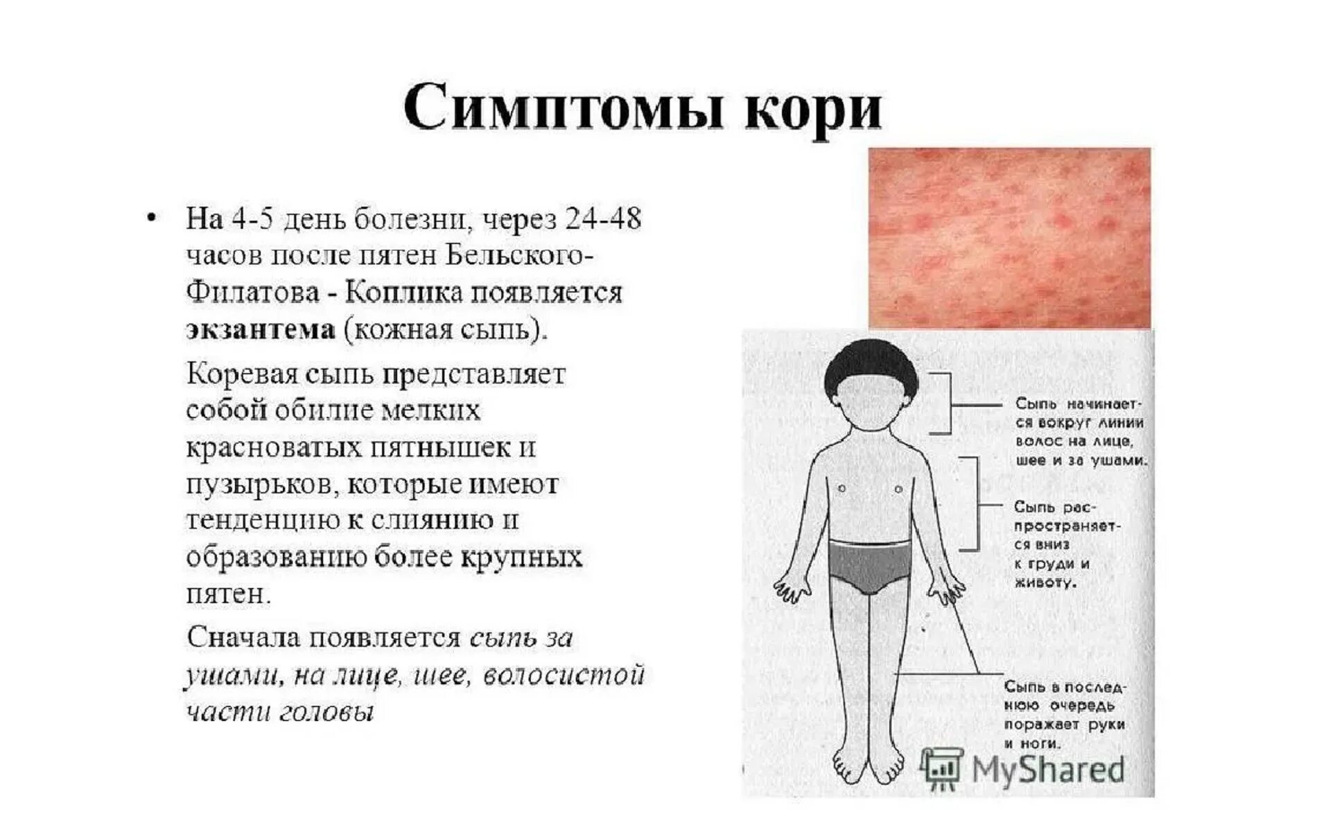 Корь у привитых взрослых. Первые элементы сыпи при кори. Краснуха корь скарлатина сыпь. Первые элементы сыпи при кори у детей.