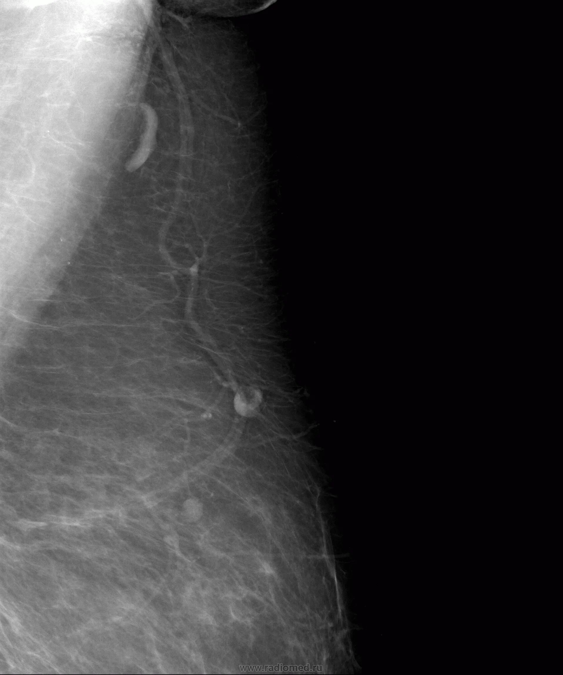 Интрамаммарный лимфоузел маммограмма. Интрамаммарный лимфоузел молочной железы рентген. Лимфатические узлы на маммографии. Интрамаммарный лимфоузел молочной железы на маммографии. Лимфоузел молочной железы маммография