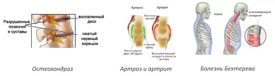 Артрит и артроз разница. Ревматоидный артрит позвоночника. Отличия артроз артрит остеохондроз. Артрит болезнь Бехтерева. Поражение позвоночника при ревматоидном артрите.