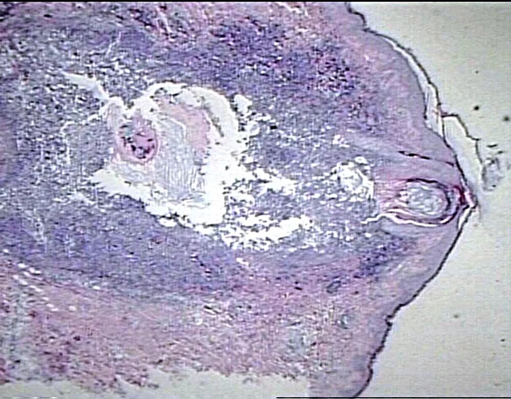 гной под микроскопом