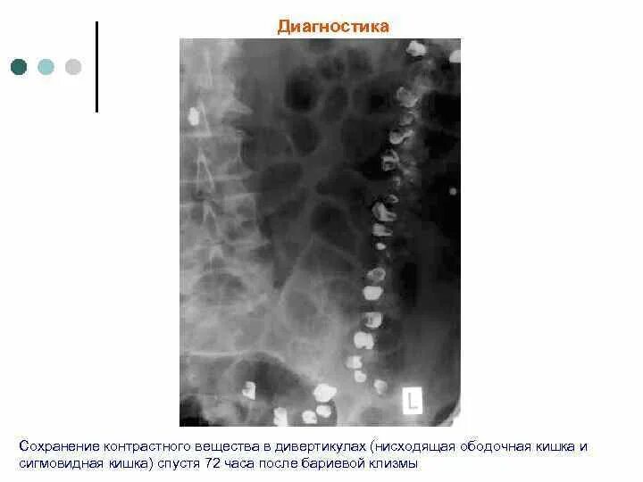 Дивертикулез сигмовидной кишки диета лечение. Диета после операции на сигмовидной кишке. Дифференциальный диагноз дивертикулы сигмовидной кишки. Операция сигмовидной кишки диета. Операция на сигмовидной кишке диета после операции.