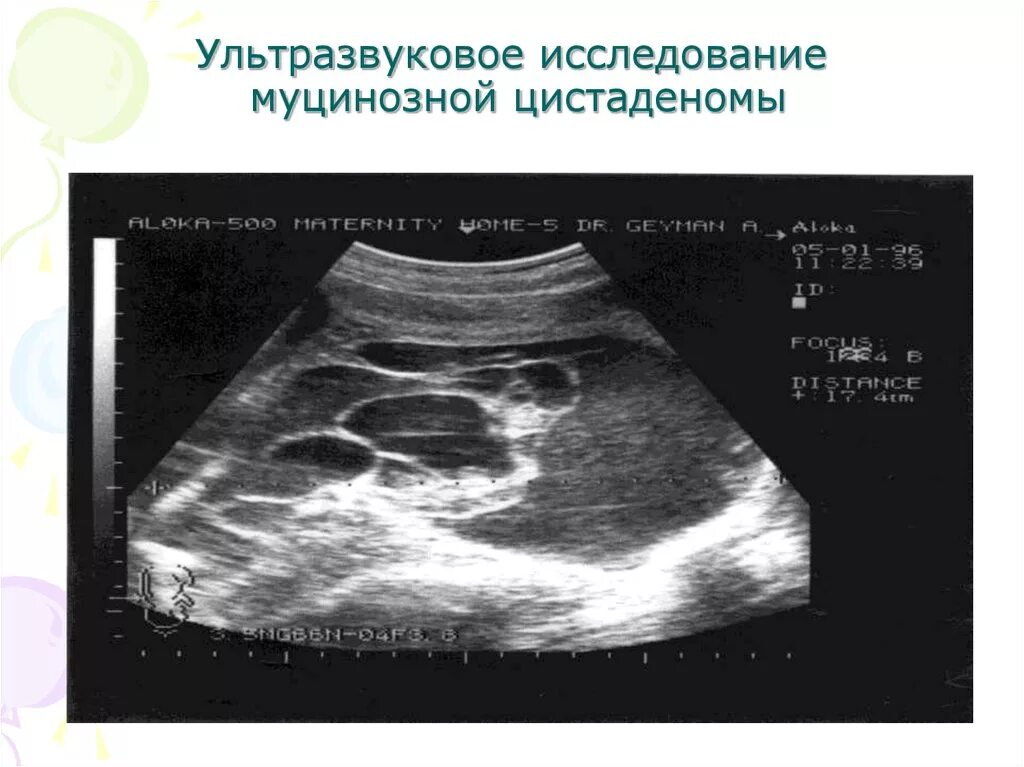 Муцинозные опухоли яичников. Папиллярная цистаденома на УЗИ. Муцинозная кистома УЗИ. Папиллярная цистаденома яичника на УЗИ. Папиллярная серозная цистаденома яичника УЗИ.