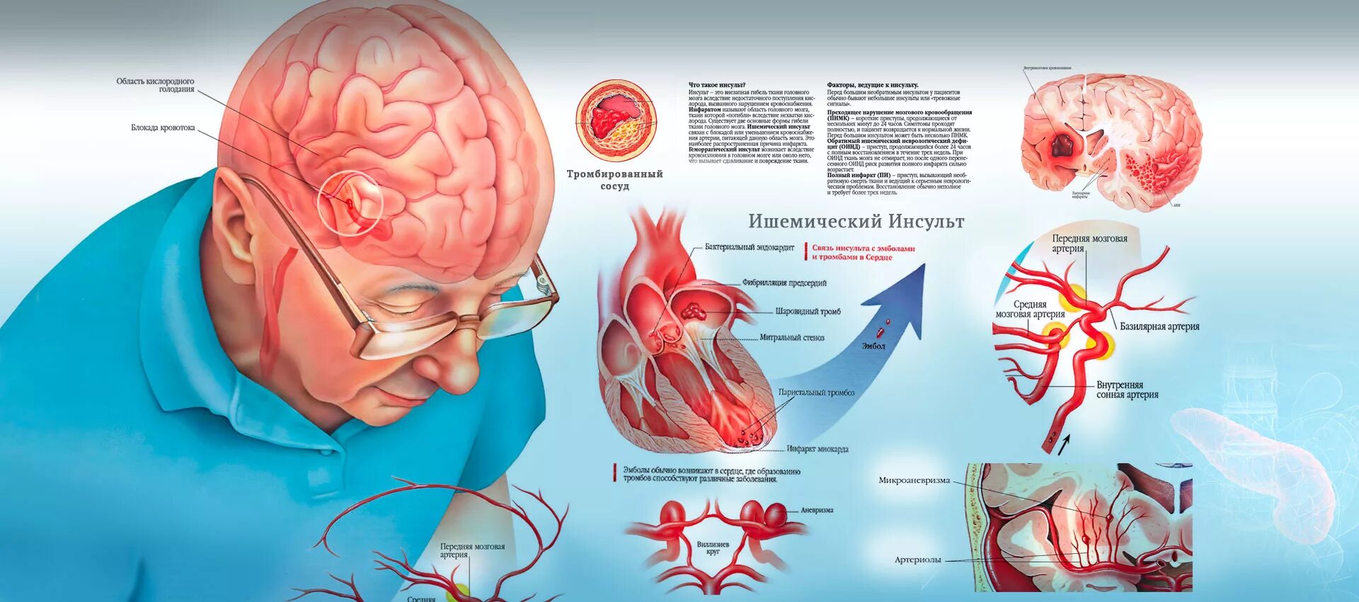 Лечение мозга после инсульта. Ишемический инсульт при ишемической болезни сердца. Инсульт осложнение ИБС.