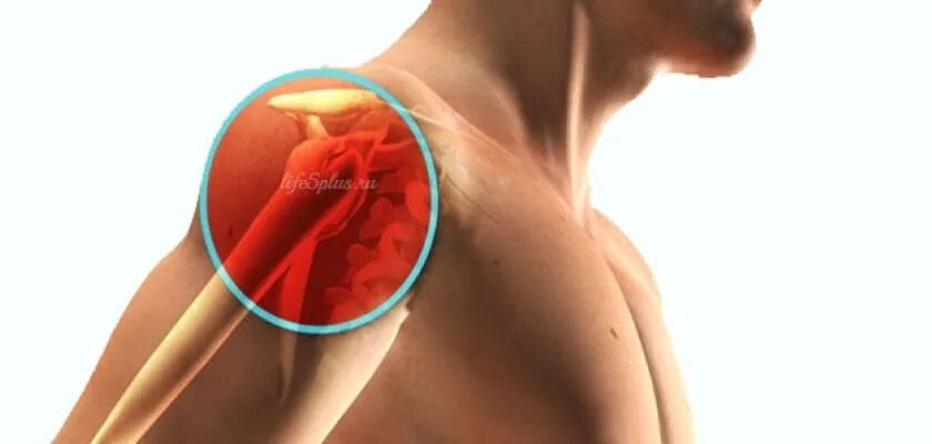 остеохондроз плечевого сустава симптомы и лечение. перелом плечевого отростка лопатки. боль в костях. синовит плечевого сустава. кт суставов, плечелопаточный периартрит.