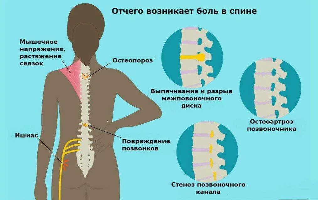 Причина боли области. What is lower back Pain?.