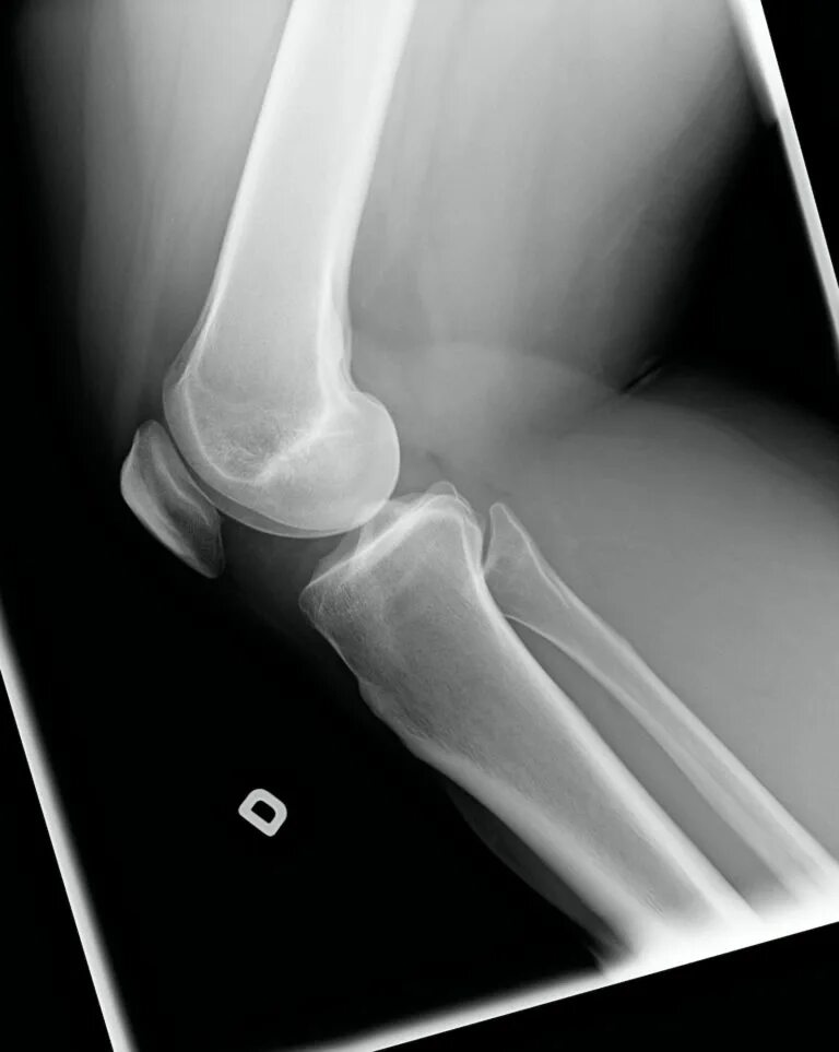 Хондромаляция надколенника рентген. Хондромаляция коленного сустава рентген. Хондромаляция бедренной кости 4 степени.