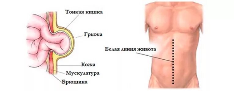 Подпупочная грыжа белой линии. Надчревные грыжи белой линии живота. Грыжа белой линии живота у ребенка. Этиология грыж белой линии.