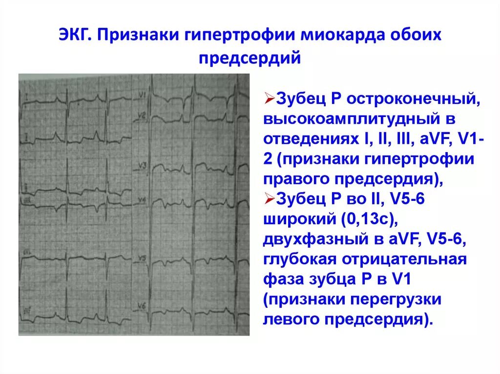 Гипертрофия левого предсердия левого желудочка. ЭКГ при гипертрофии миокарда левого предсердия. ЭКГ-изменения при гипертрофиях миокарда.. Критерии гипертрофии миокарда на ЭКГ. Признаки гипертрофии правого предсердия на ЭКГ.