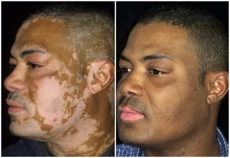 Vitiligo is a common condition that affects self-esteem but it can be treat...
