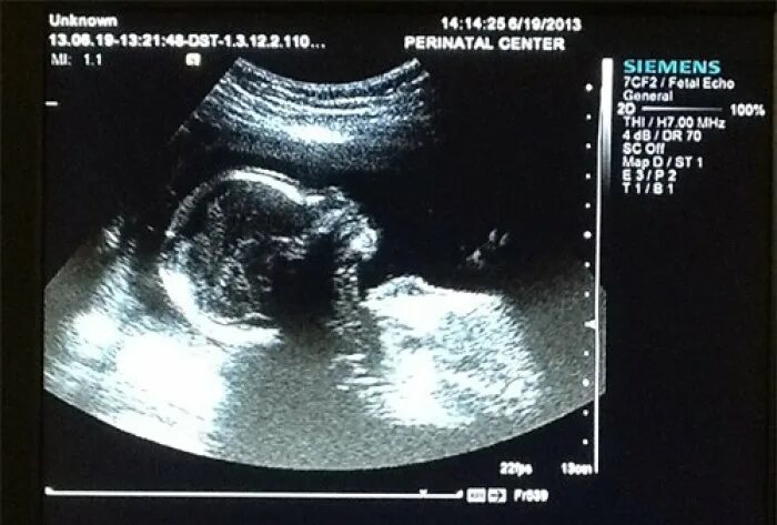 узи первый скрининг нормы 12 недель. узи первый скрининг синдром дауна. узи-скрининг 1 синдром дауна. пренатальная диагностика синдрома эдвардса.