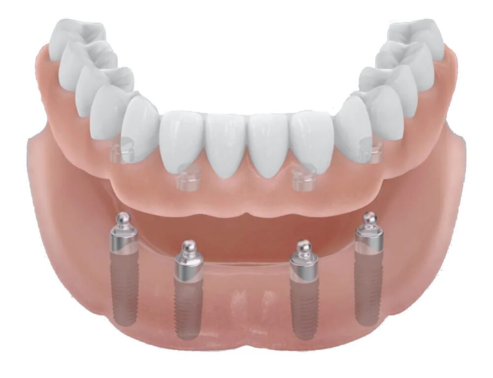 All on 4 имплантация нобель. All on 4 имплантация нобель. Покрывной протез на 2 имплантах. Протезирование с использованием имплантатов. Имплантация челюсти на 6 имплантах.