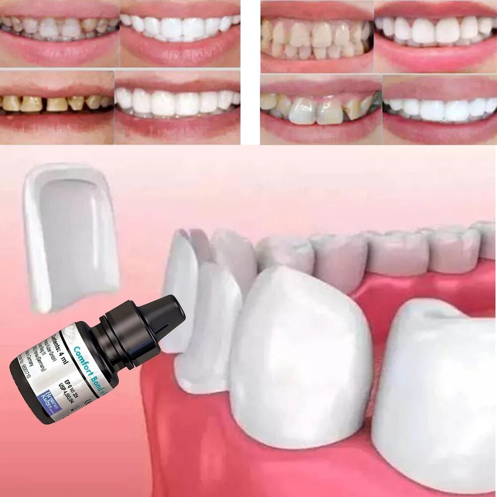 Чем можно приклеить зуб. Стоматологический клей для коронок. Зубная коронка. Клей коронки стоматологический для зубной.