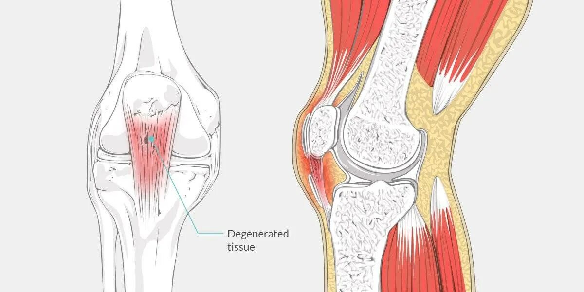 Боль коленной связки. Тендинит собственной связки надколенника. Тендинит сухожилия подколенной мышцы. Воспаление сухожилия надколенника. Воспаление связки надколенника.