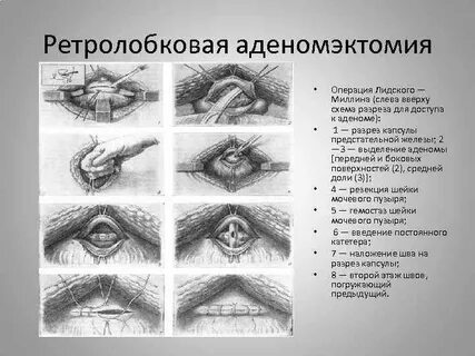 Аденэктомия