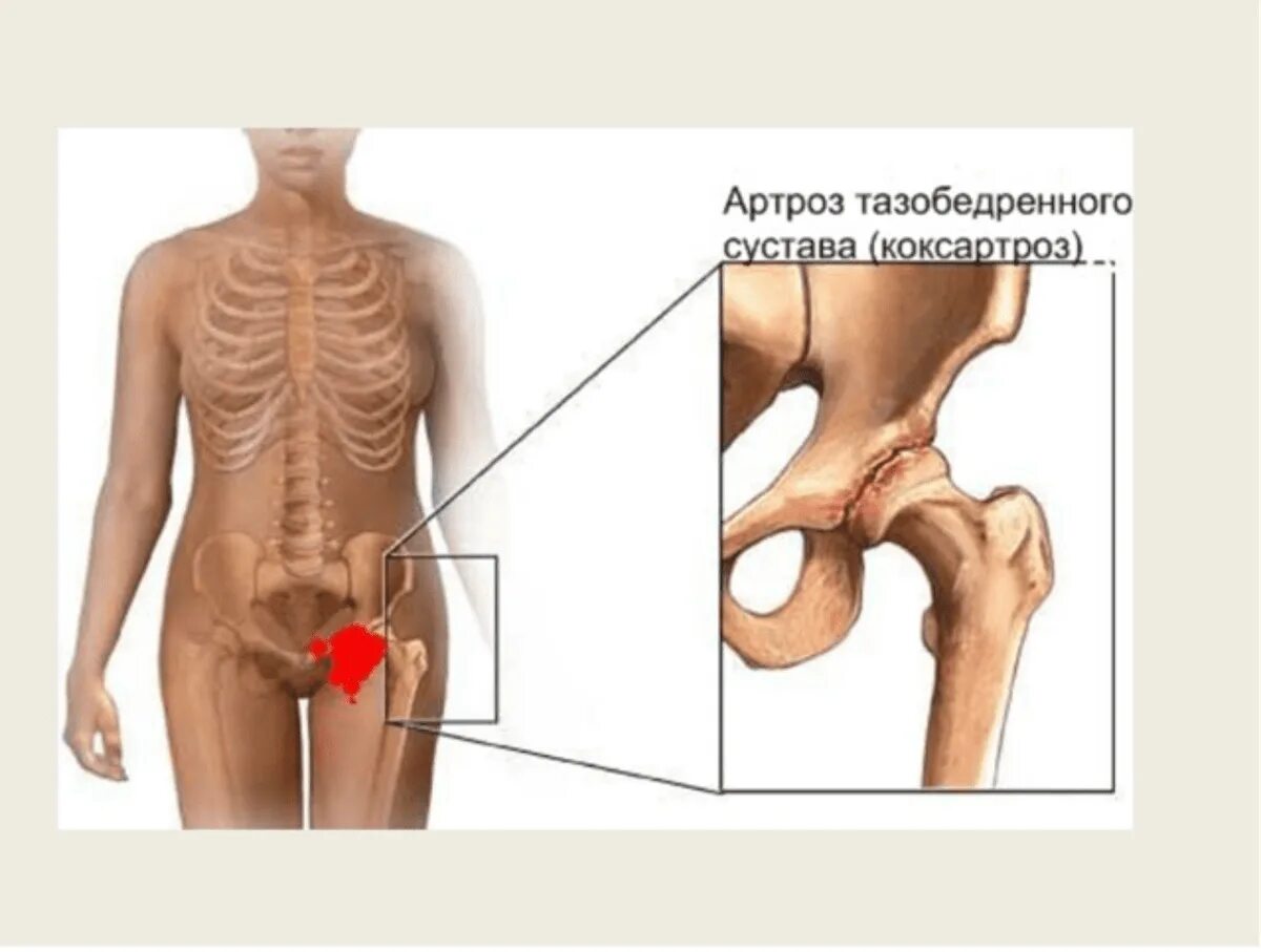 Какая боль при коксартрозе. Коксит тазобедренного сустава. Коксалгия тазобедренного сустава. Тазобедренный сустав при коксартрозе. Тазобедренный сустав с левой стороны.