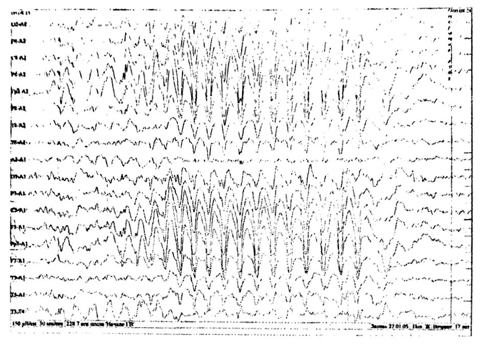 Спайк на ээг. Спайки на ЭЭГ. Спайк волна на ЭЭГ. Ирритативные нарушения на ЭЭГ. Паттерны ЭЭГ 6-8 герцовые спайки.