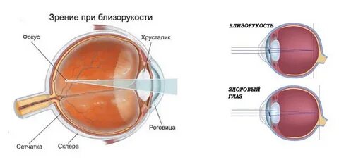 Миопия москва