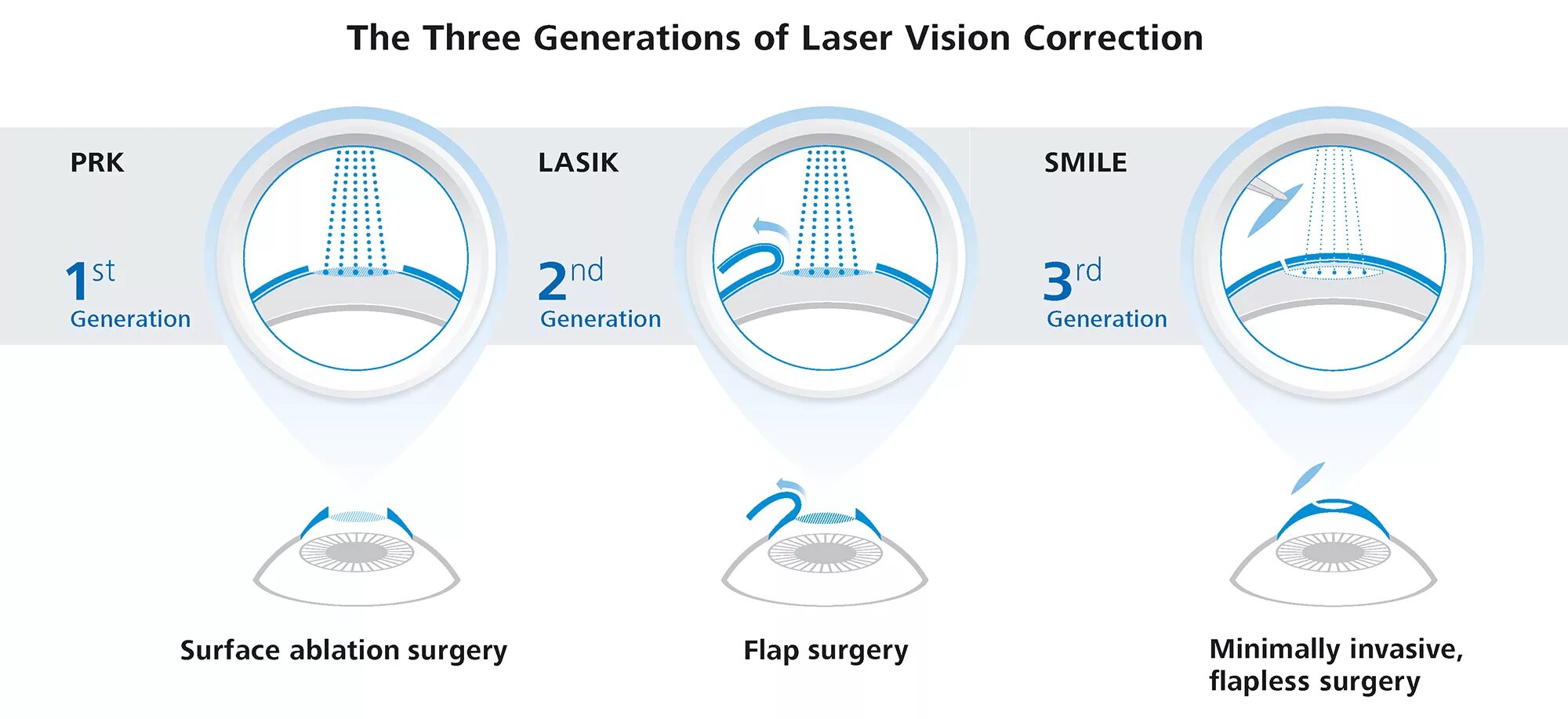 Коррекция зрения смайл цена со скидкой спектр. Метод лазерной коррекции RELEX smile. Лазерная операция ФРК. Методы лазерной коррекции LASIK. Операция на глаза методом ласик.