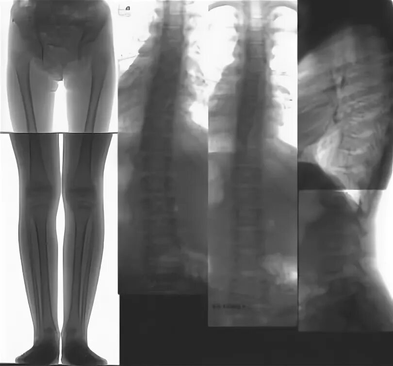Рентген нижних конечностей. Панорамная рентгенограмма нижних конечностей. Полноформатная рентгенография. Отсканировать рентгеновский снимок.