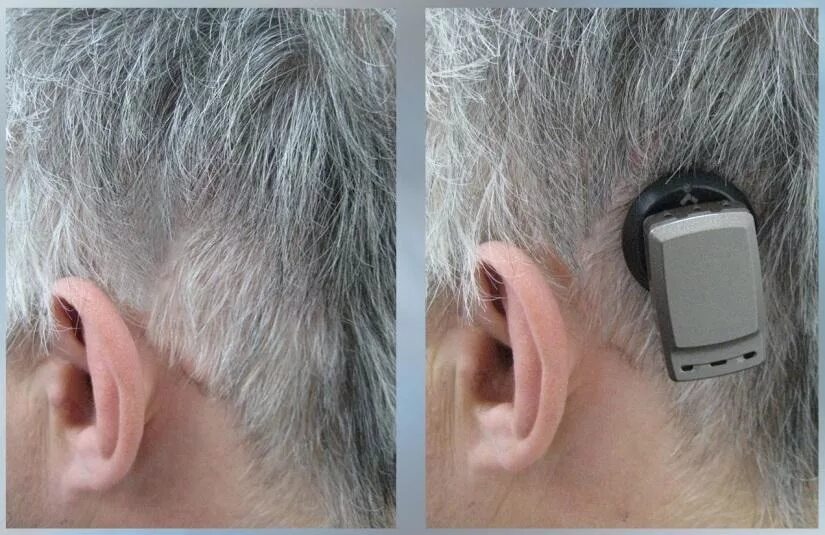 костный слуховой. слуховой аппарат cochlear 8. Medel кохлеарный имплант. костный слуховой. слуховой аппарат костной проводимости baha.
