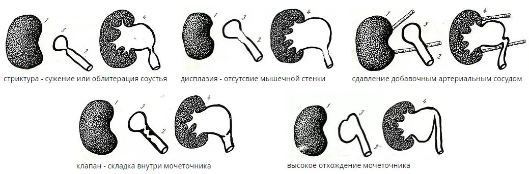 Мочеточникового сегмента. Мочеточникового сегмента