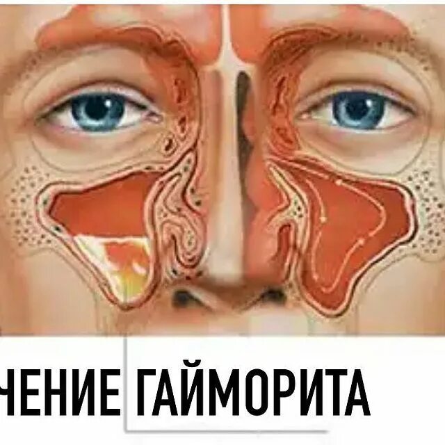 скопление в лобных пазухах. мукоцеле верхнечелюстной пазухи кт. аплазия лобной пазухи кт. фронтит трепанопункция. синусит верхнечелюстной пазухи.