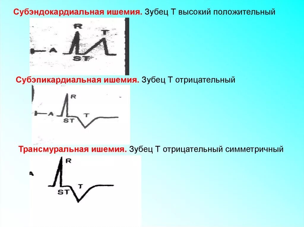 St ишемия. ЭКГ зубец т отрицательный v5. Зубец т при ишемии на ЭКГ. ЭКГ отрицательный зубец т в v1-v3. Двухфазные зубцы на ЭКГ.