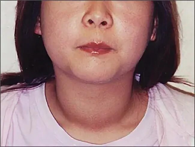 Хашимото болезнь у женщин. Хашимото лицо больного. Пациенты с тиреоидитом Хашимото.