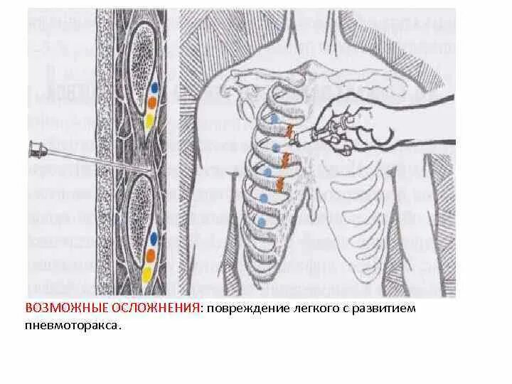 Нервная блокада. Блокада бедренного нерва показания. Новокаиновая блокада при пневмотораксе. Блокада нервных стволов. Ориентиры блокады бедренного нерва.