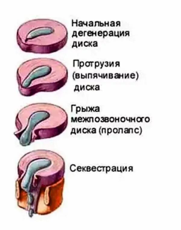Протрузия дисков шейного отдела лечение. Протрузия межпозвоночного диска. протру́зия межпозвонкового диска. протрузия пролабирование экструзия. протрузии экструзии межпозвонковых дисков.