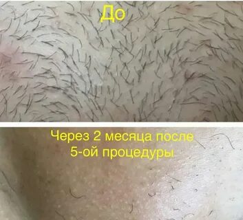 Электроэпиляция бикини сколько