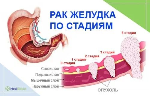 Опухоль желудка 4 стадия. Карцинома желудка 4 стадия. Онкология желудка 4 стадия