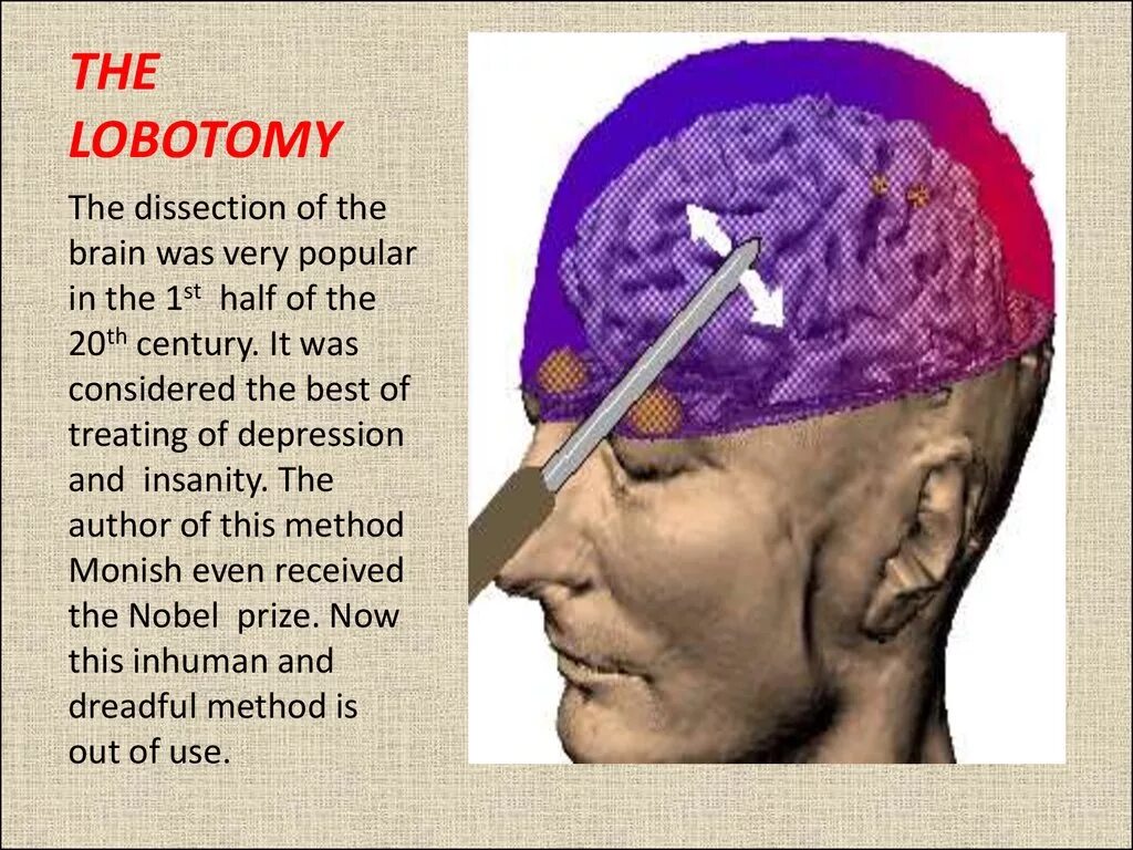 Лоботомия сейчас делают. Орбитокласт Лоботомия. Префронтальную лоботомию.