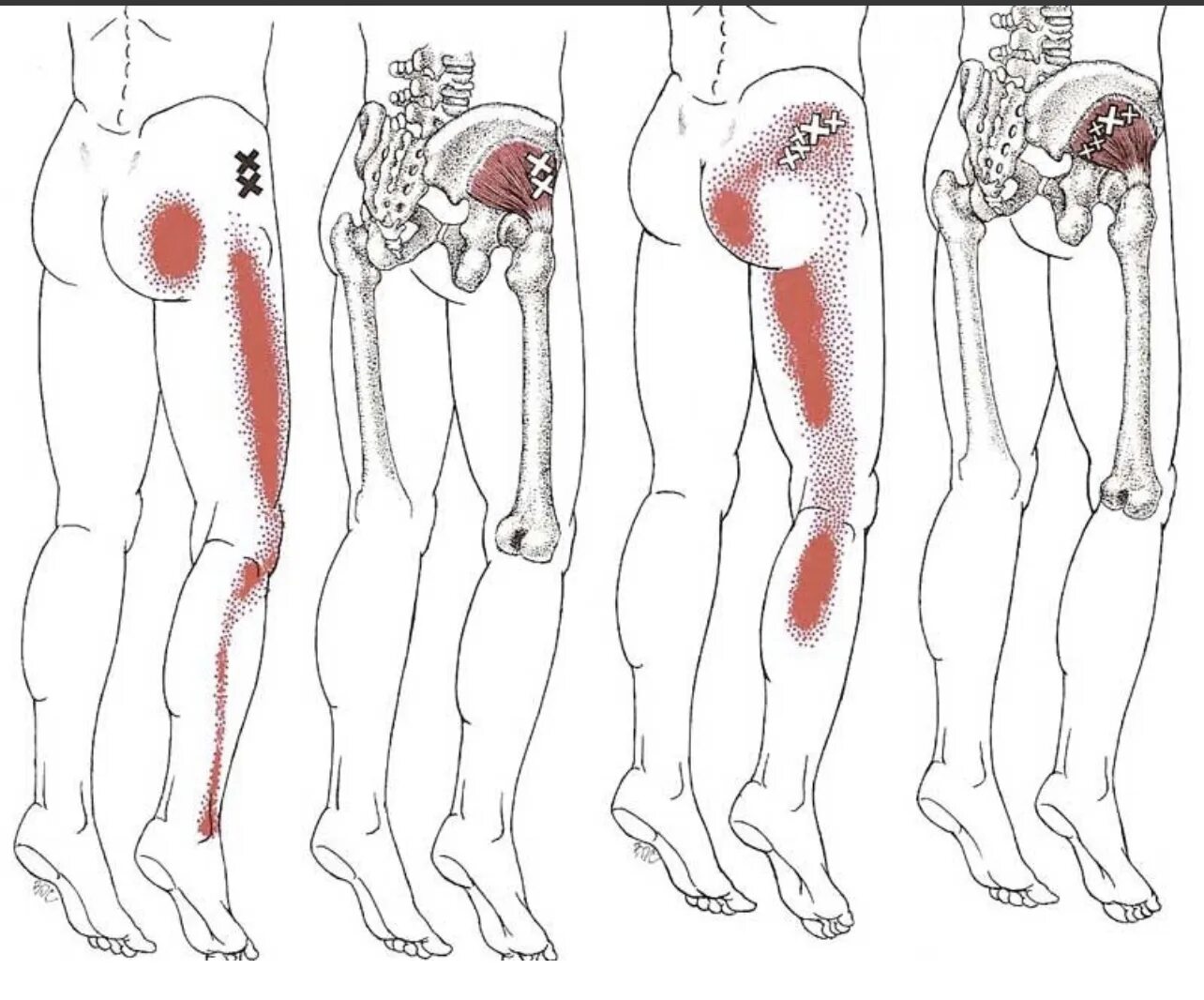 Нога на ногу что значит у мужчин. Триггерные точки в мышцах тазобедренного сустава. Триггерные точки грушевидной мышцы. Синдром грушевидной мышцы триггерные точки. Триггерные точки ягодичной мышцы.
