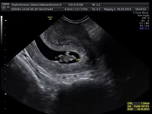 Передача 7 недель. Желточный мешок 3 мм УЗИ. УЗИ желточный мешочек 7.3 мм. УЗИ 7 недель 3 дня беременности.