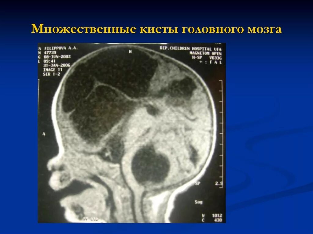 Паренхиматозная киста головного мозга. Микроскопическое строение кисты головного мозга. Посттравматическая киста головного мозга кт. Множественные кисты в головном мозге.