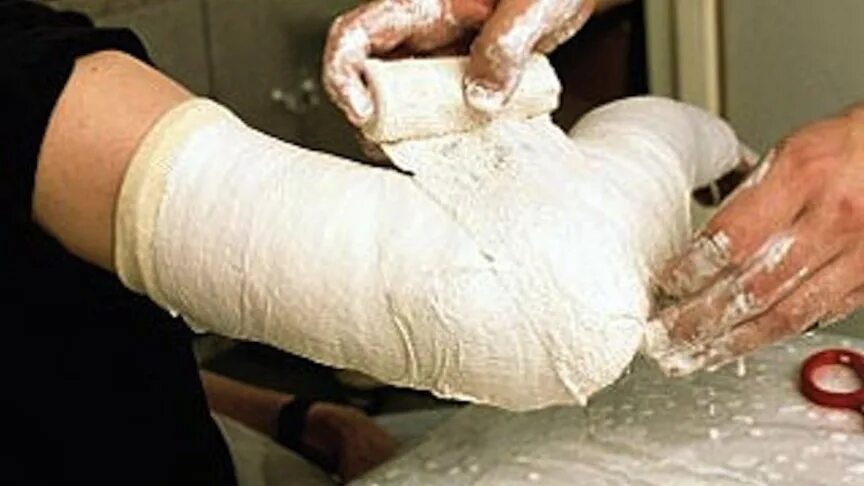 Перелом 5 пястной кости гипсовая повязка. Перелом локтя гипс. Повязка на локоть при переломе. Гипс при переломе локтевого сустава. Лонгета при переломе лучевой кости.