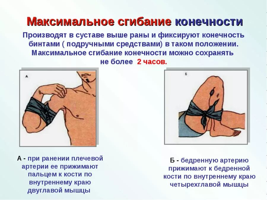 Метод максимального сгибания конечности при кровотечении. Остановка кровотечения методом сгибания конечностей. Остановка кровотечения максимальным сгибанием конечности алгоритм. Максимальное сгибание конечности при кровотечении. Венозное кровотечение первая помощь алгоритм