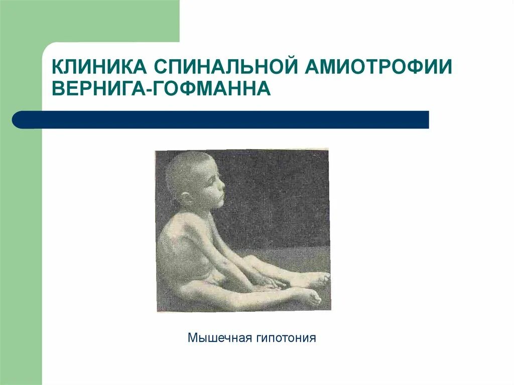Симптомы спинальной мышечной