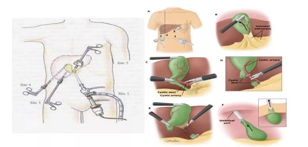 После удаления желчного пузыря. Лапароскопическая холецистэктомия схема операции. Холецистэктомия троакары. Лапароскопическая холецистэктомия этапы операции. Лапаротомия лапароскопия холецистэктомия.