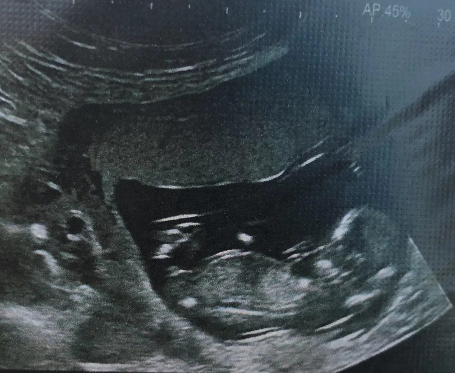 Узим мальчик 13 недель беременности. Девочка на 13 неделе. Мальчик и девочка на узи в 12 недель беременности. Узи 12 недель беременности скрининг девочка. Девочка на 13 неделе.