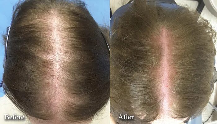 PRP Treatment Before and After Female Limmer Hair Transplant Center