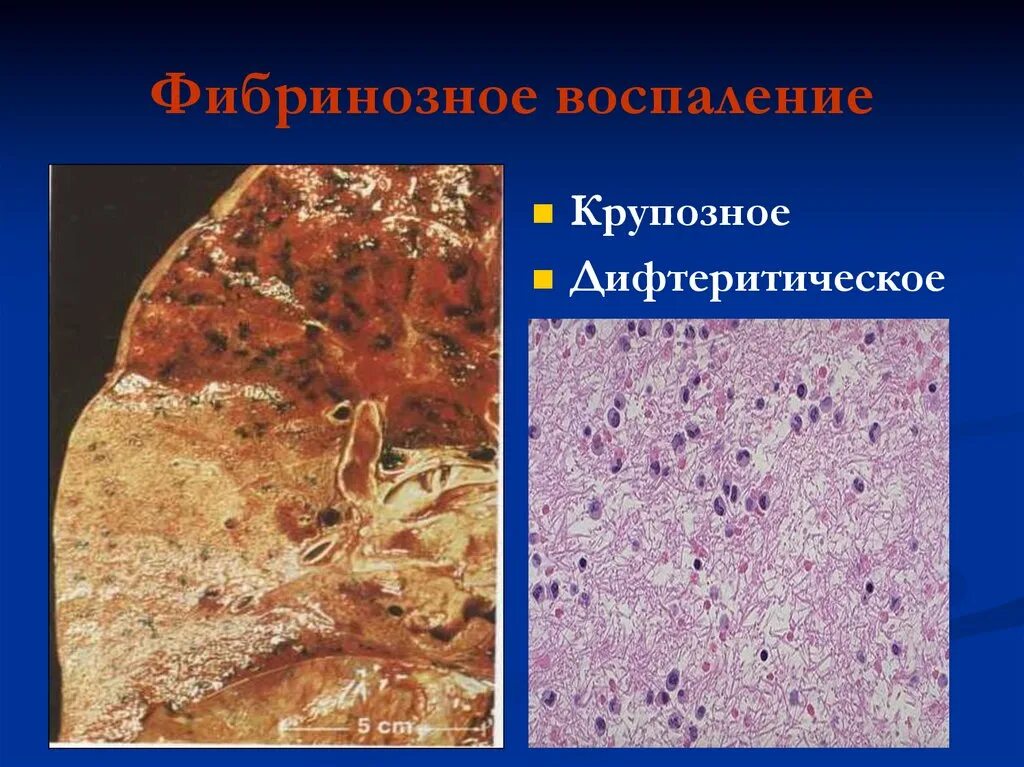 Воспаление ткани латынь. Дифтеритический экссудат это. Крупозное фибринозное воспаление. Фибринозное дифтеритическое воспаление. Дифтеричечкое фибриночное воспаленик.