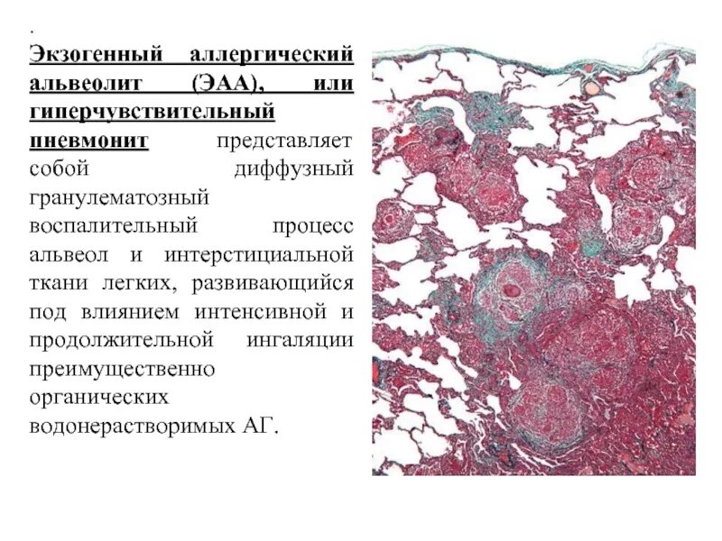 Аллергический альвеолит патанатомия. Фиброзирующий альвеолит патоморфология. Экзогенный аллергический альвеолит микропрепарат.