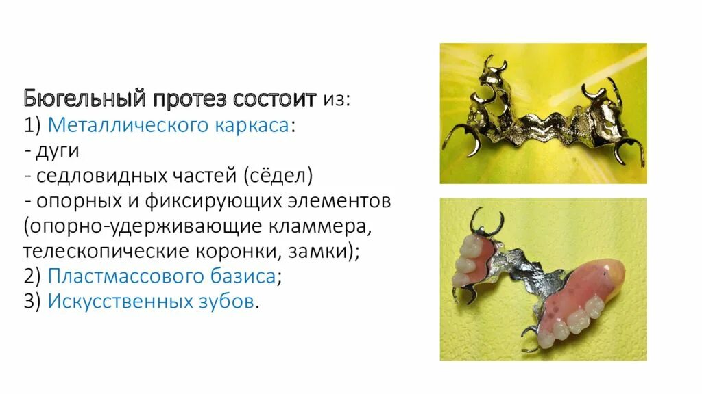 Преимущества и недостатки бюгельных протезов. Преимущества и недостатки бюгельных протезов