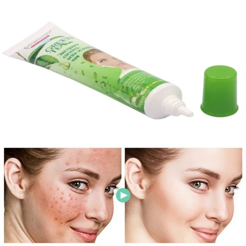 Blackhead pore cream. Крем от угрей на лице. Крем от прыщей.