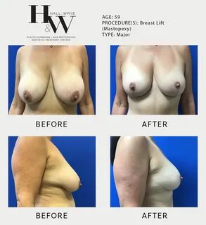 Breast lift (mastopexy) .