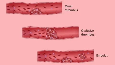 Real clot