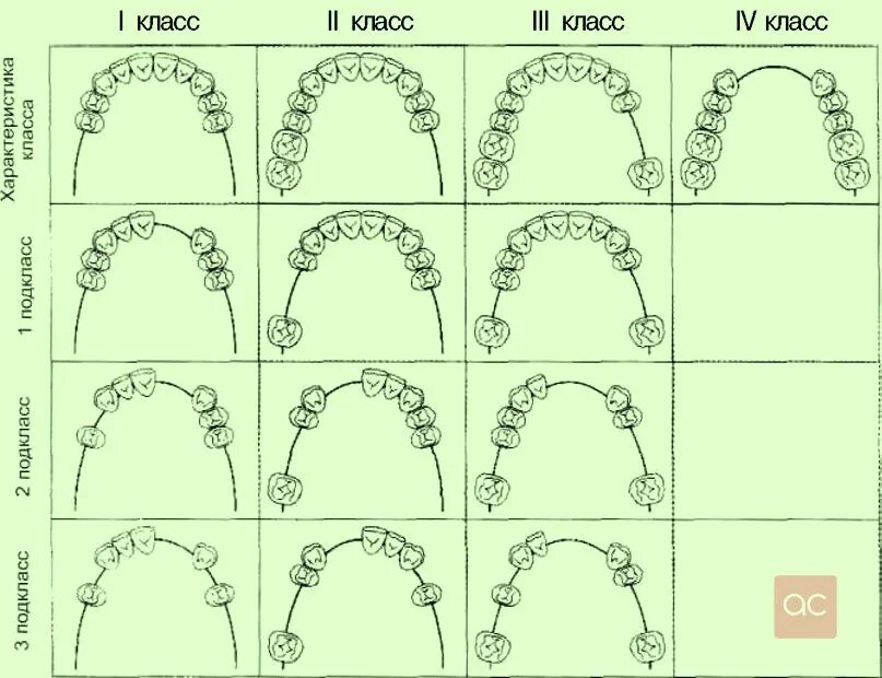 2 класс 2 подкласс по кеннеди. Классификация зубных рядов по кеннеди. Классификация дефектов зубных рядов по кеннеди. 2 класс 1 подкласс по кеннеди. Классификация по кеннеди в ортопедической.
